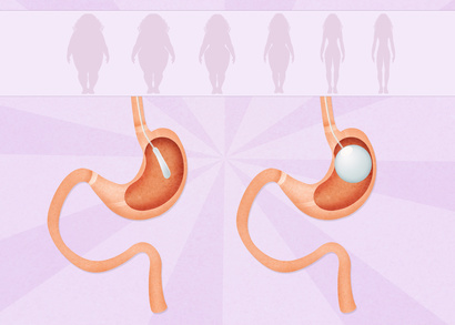 Before Considering Gastric Bypass Surgery Be Sure That It Is Covered By Your Insurance